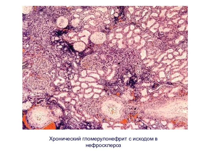 Хронический гломерулонефрит с исходом в нефросклероз