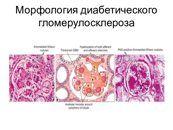 Морфология диабетического гломерулосклероза