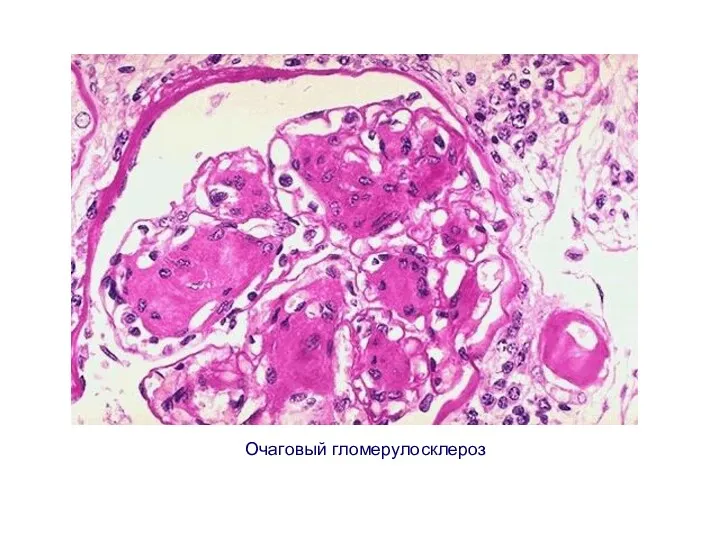 Очаговый гломерулосклероз