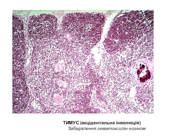 ТИМУС (акцідентальна інволюція) Забарвлення гематоксилін-еозіном