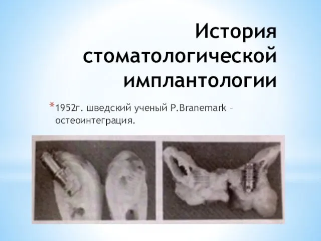 История стоматологической имплантологии 1952г. шведский ученый P.Branemark – остеоинтеграция.