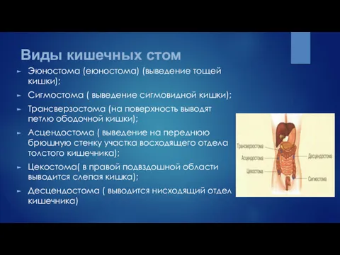 Виды кишечных стом Эюностома (еюностома) (выведение тощей кишки); Сигмостома (