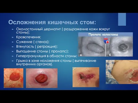 Осложнения кишечных стом: Околостомный дерматит ( раздражение кожи вокруг стомы); Кровотечения; Сужение (