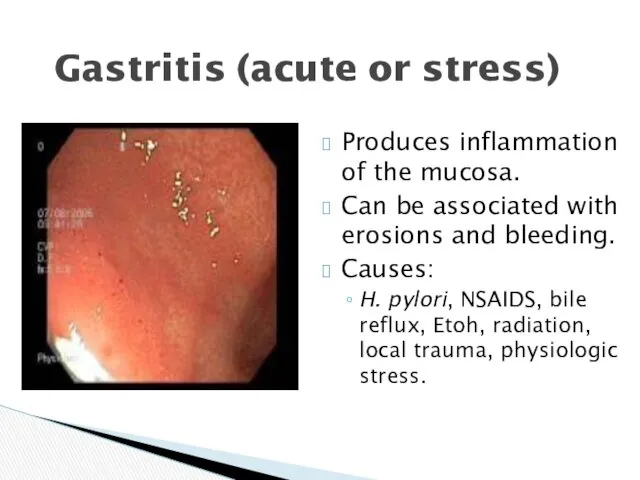 Gastritis (acute or stress) Produces inflammation of the mucosa. Can be associated with