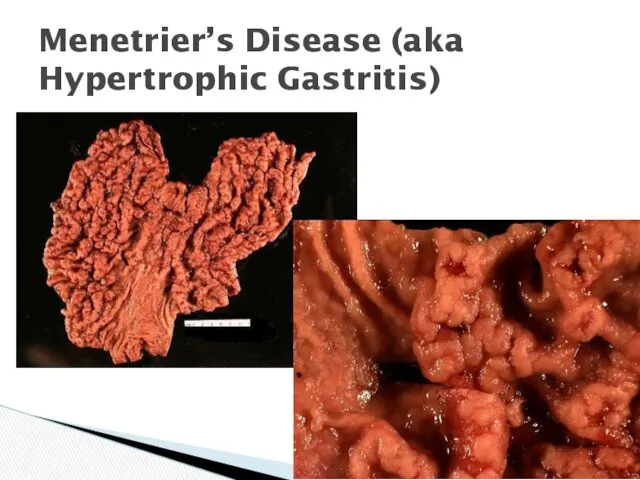 Menetrier’s Disease (aka Hypertrophic Gastritis)