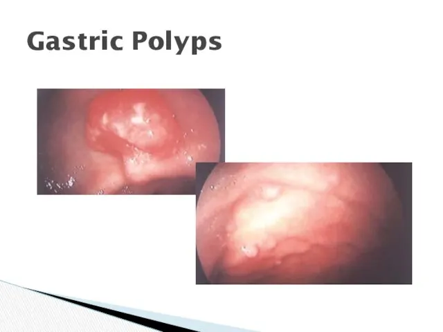Gastric Polyps