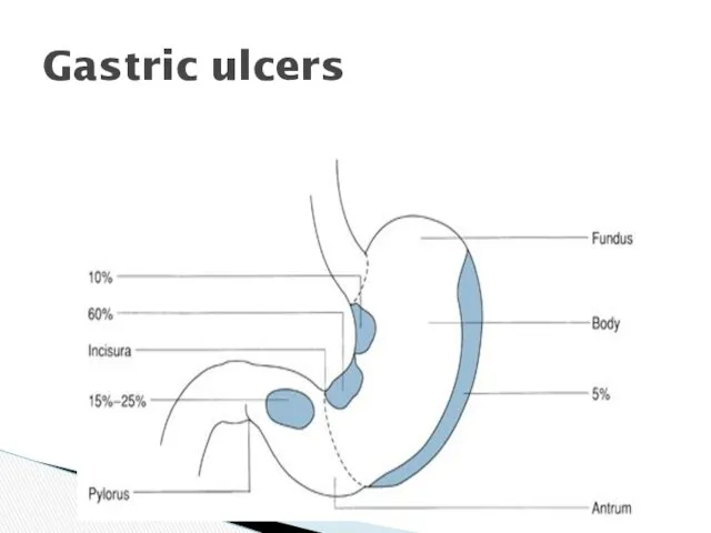 Gastric ulcers