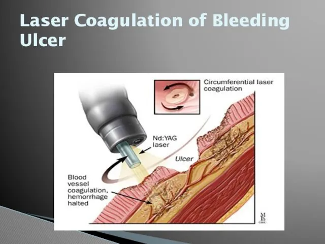 Laser Coagulation of Bleeding Ulcer