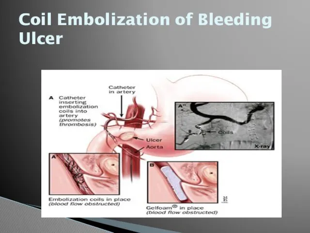 Coil Embolization of Bleeding Ulcer