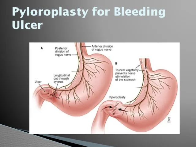 Pyloroplasty for Bleeding Ulcer