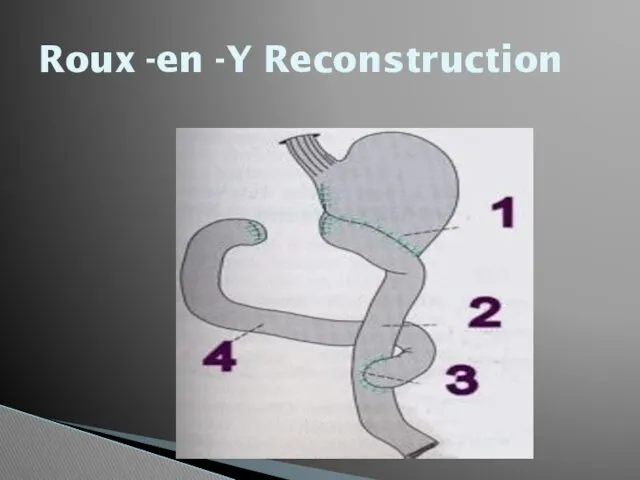 Roux -en -Y Reconstruction