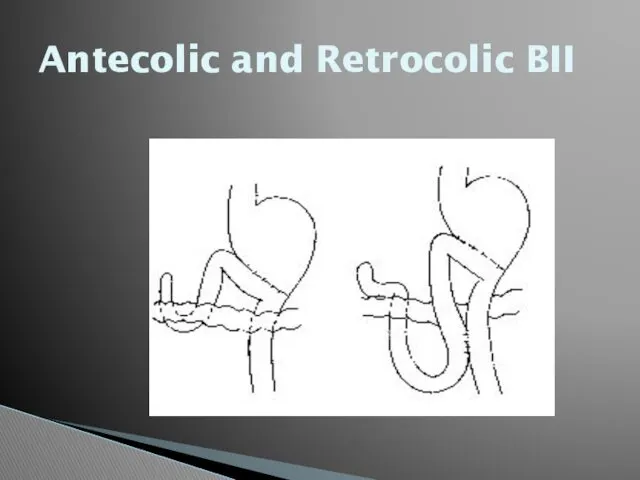 Antecolic and Retrocolic BII