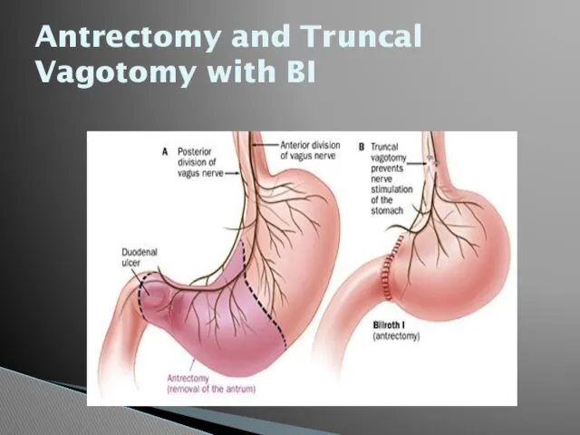 Antrectomy and Truncal Vagotomy with BI