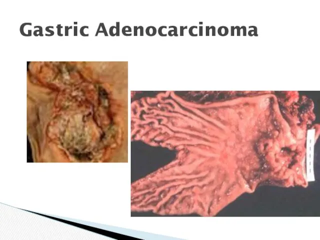 Gastric Adenocarcinoma