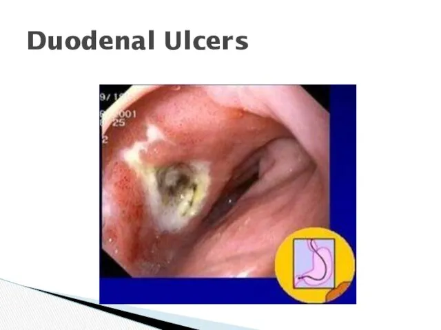 Duodenal Ulcers