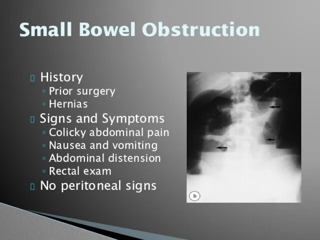 Small Bowel Obstruction History Prior surgery Hernias Signs and Symptoms
