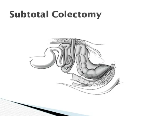 Subtotal Colectomy