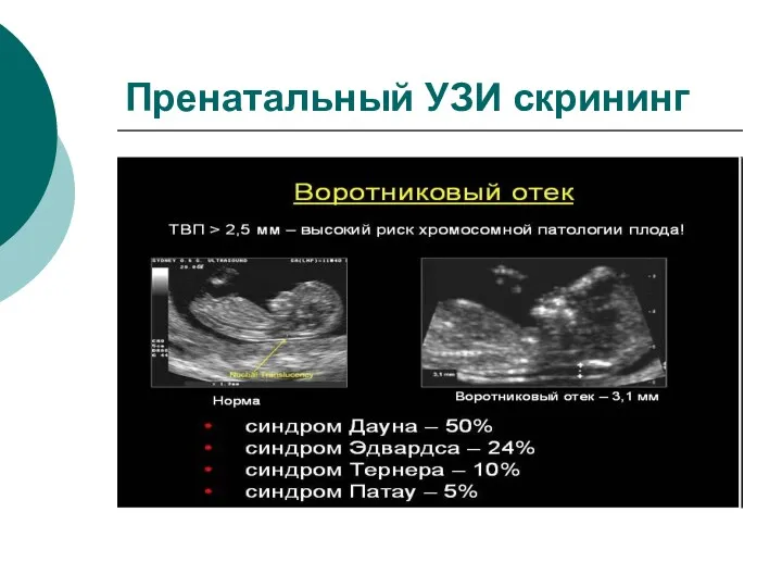 Пренатальный УЗИ скрининг