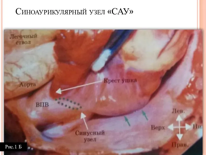 Синоаурикулярный узел «САУ» Рис.1 Б