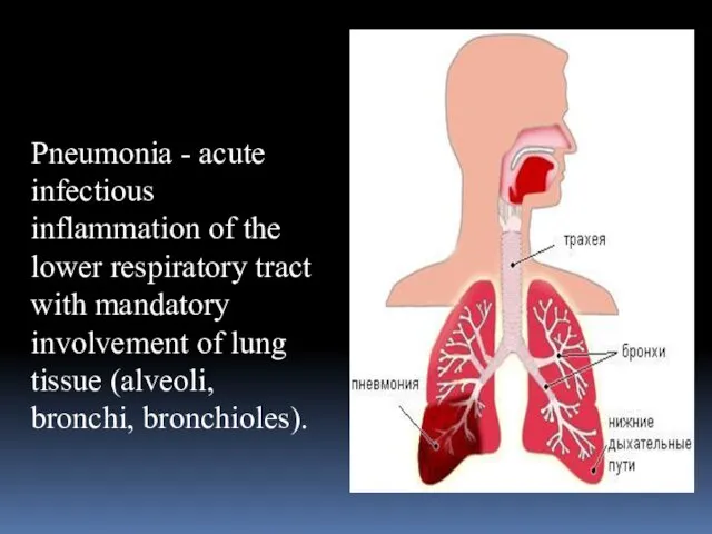 Pneumonia - acute infectious inflammation of the lower respiratory tract