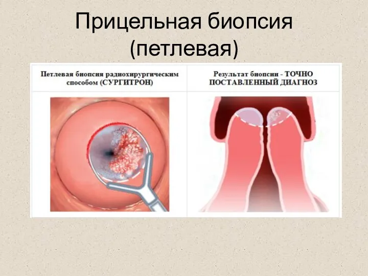 Прицельная биопсия (петлевая)