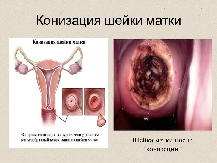 Конизация шейки матки Шейка матки после конизации