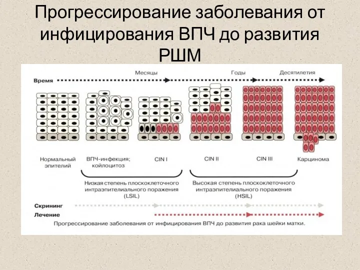 Прогрессирование заболевания от инфицирования ВПЧ до развития РШМ