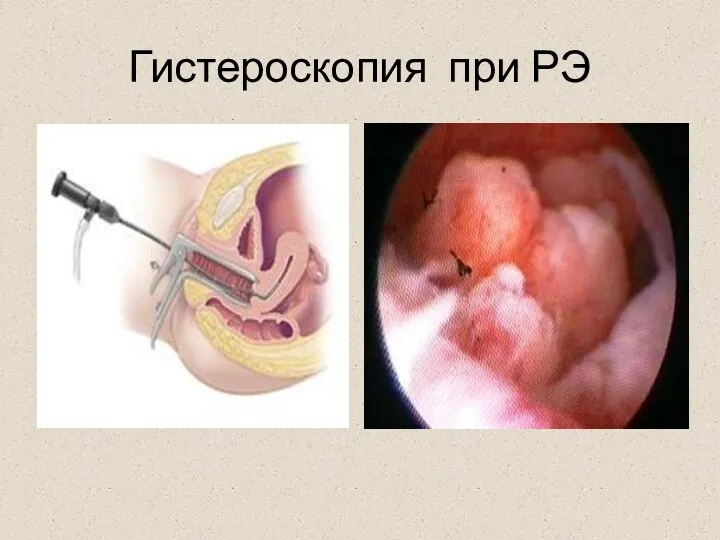 Гистероскопия при РЭ