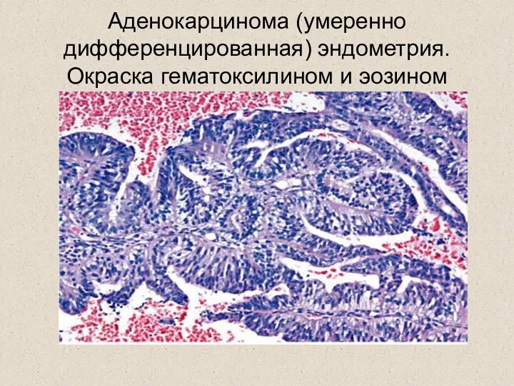 Аденокарцинома (умеренно дифференцированная) эндометрия. Окраска гематоксилином и эозином