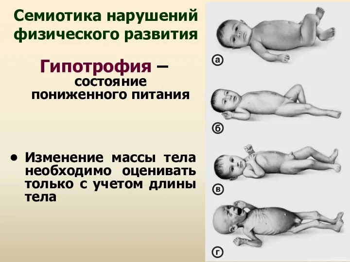 Семиотика нарушений физического развития Гипотрофия – состояние пониженного питания Изменение