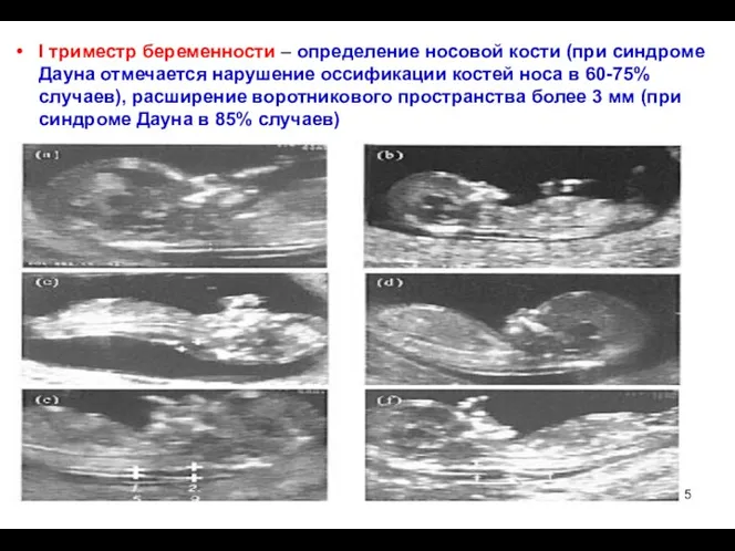 I триместр беременности – определение носовой кости (при синдроме Дауна отмечается нарушение оссификации