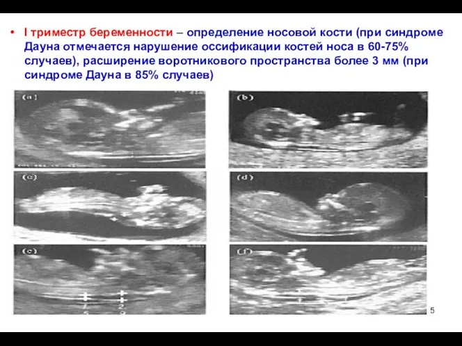 I триместр беременности – определение носовой кости (при синдроме Дауна