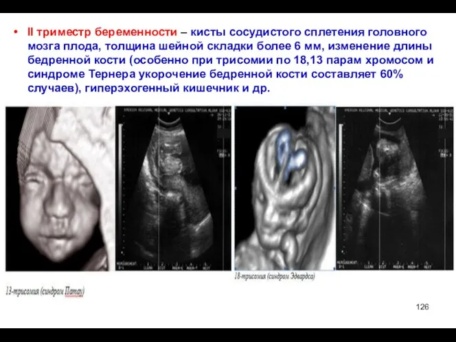 II триместр беременности – кисты сосудистого сплетения головного мозга плода, толщина шейной складки