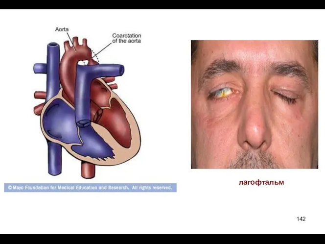 лагофтальм