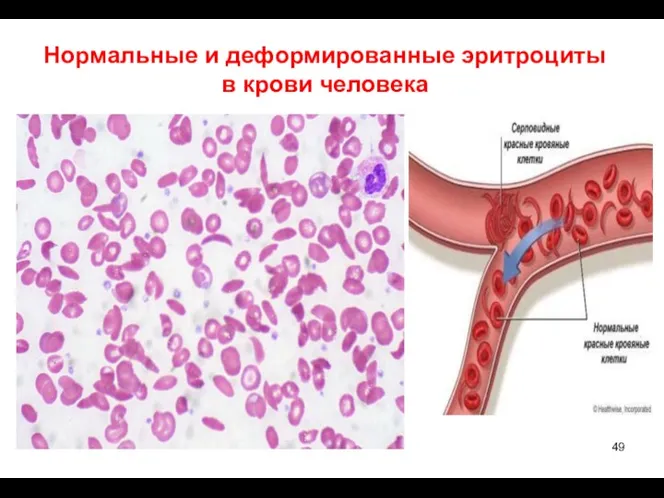 Нормальные и деформированные эритроциты в крови человека