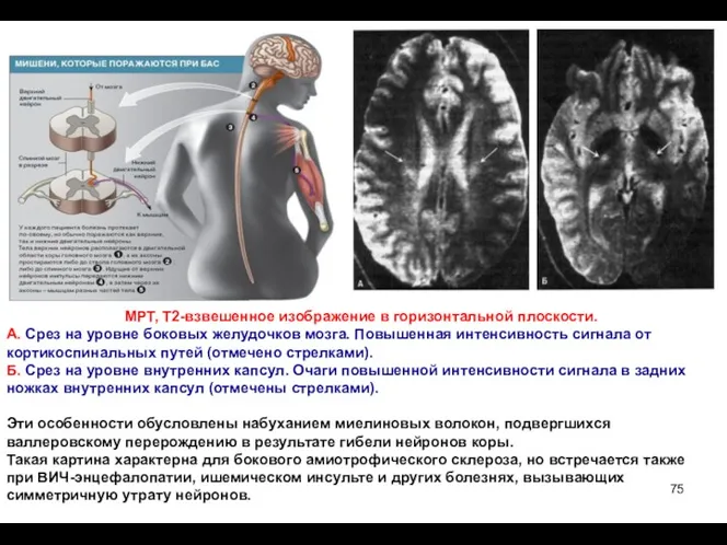 МРТ, Т2-взвешенное изображение в горизонтальной плоскости. А. Срез на уровне боковых желудочков мозга.