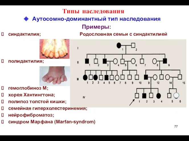 Типы наследования Аутосомно-доминантный тип наследования Примеры: синдактилия; Родословная семьи с синдактилией полидактилия; гемоглобиноз