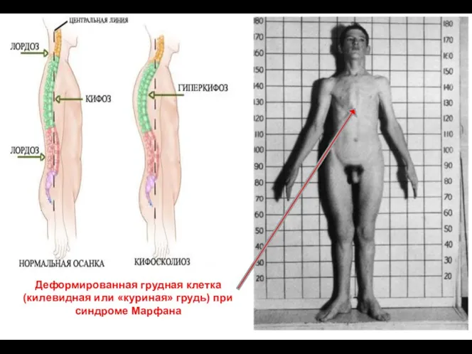 Деформированная грудная клетка (килевидная или «куриная» грудь) при синдроме Марфана