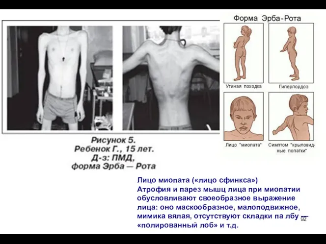 Лицо миопата («лицо сфинкса») Атрофия и парез мышц лица при миопатии обусловливают своеобразное