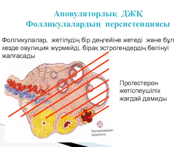 Ановуляторлық ДЖҚ Фолликулалардың персистенциясы Фолликулалар, жетілудің бір деңгейіне жетеді және