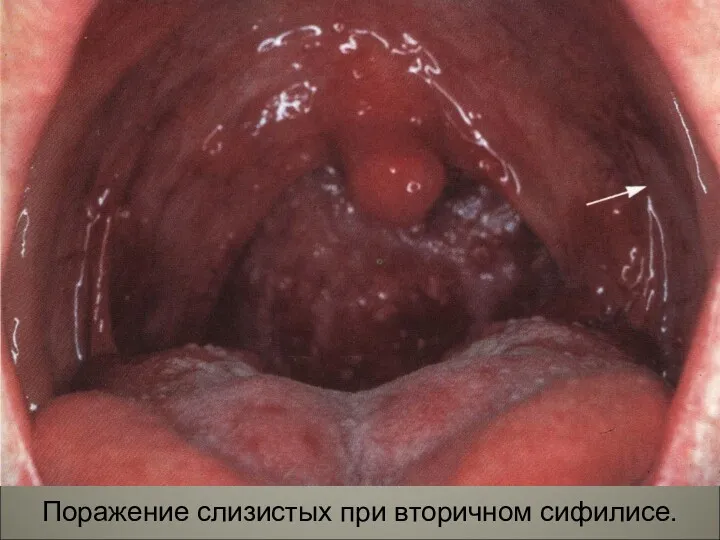 Поражение слизистых при вторичном сифилисе.