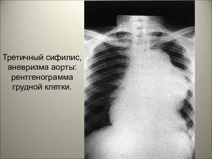 Третичный сифилис, аневризма аорты: рентгенограмма грудной клетки.