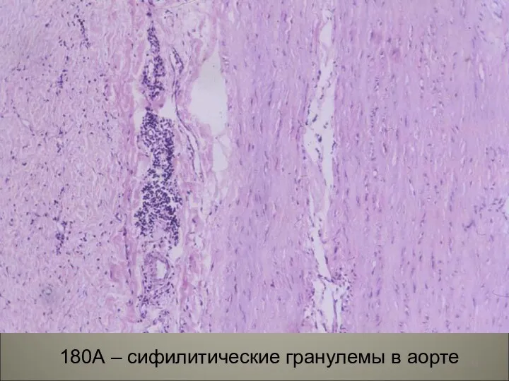 180А – сифилитические гранулемы в аорте