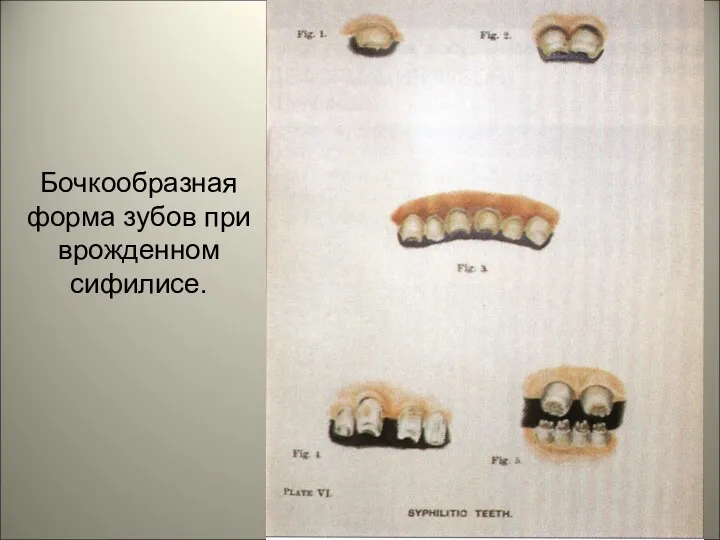 Бочкообразная форма зубов при врожденном сифилисе.