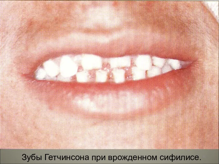 Зубы Гетчинсона при врожденном сифилисе.