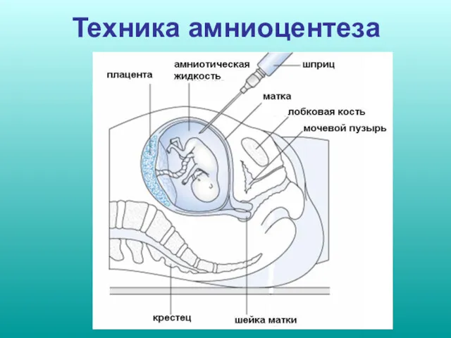 Техника амниоцентеза