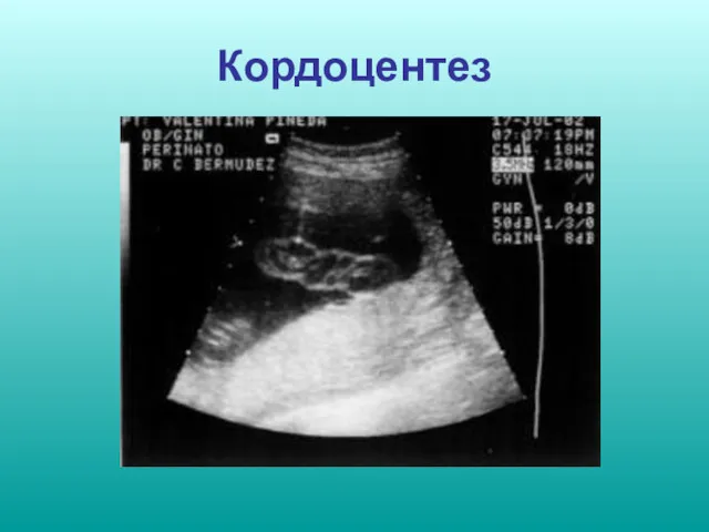 Кордоцентез