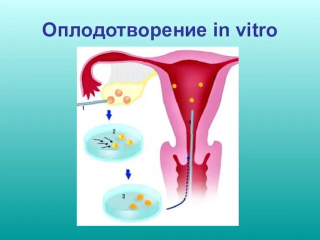 Оплодотворение in vitro