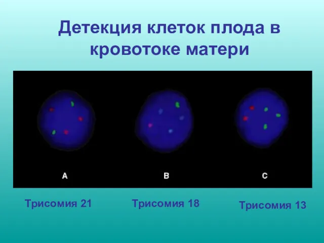 Детекция клеток плода в кровотоке матери Трисомия 21 Трисомия 18 Трисомия 13
