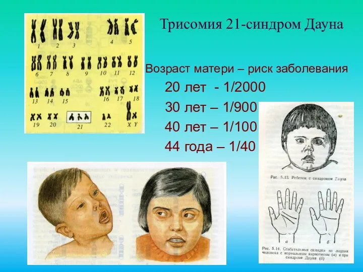 Трисомия 21-синдром Дауна Возраст матери – риск заболевания 20 лет